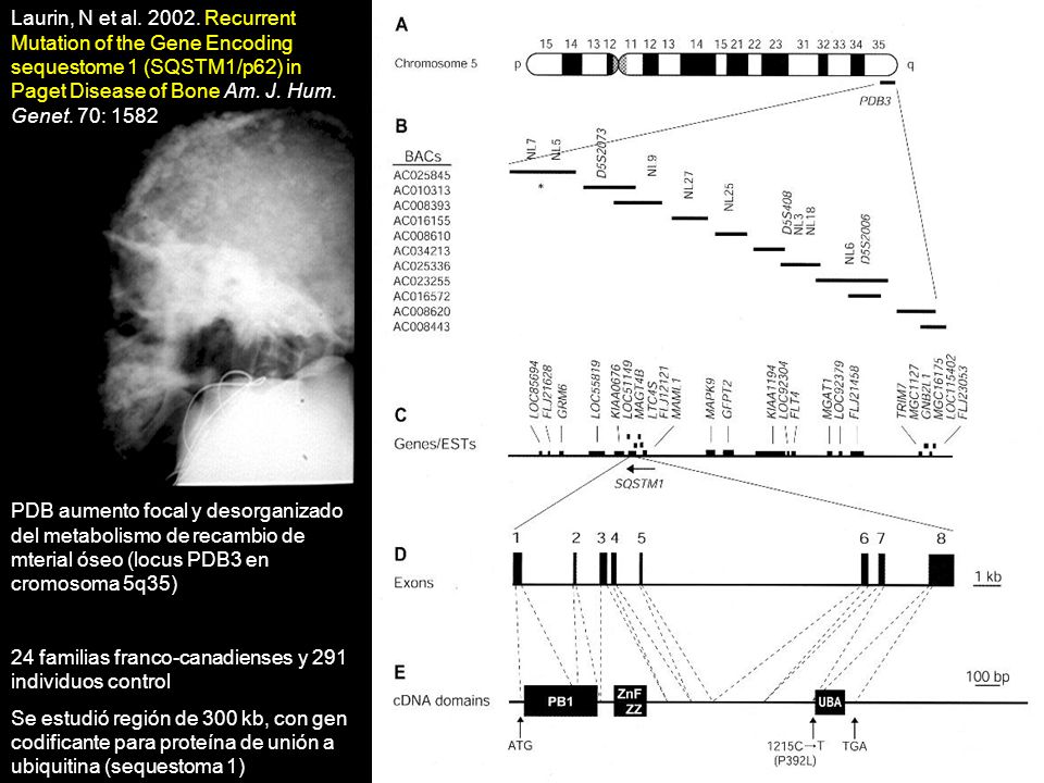 Laurin, N et al Recurrent Mutation of the Gene Encoding sequestome 1 (SQSTM1/p62) in Paget Disease of Bone Am. J. Hum. Genet. 70: 1582