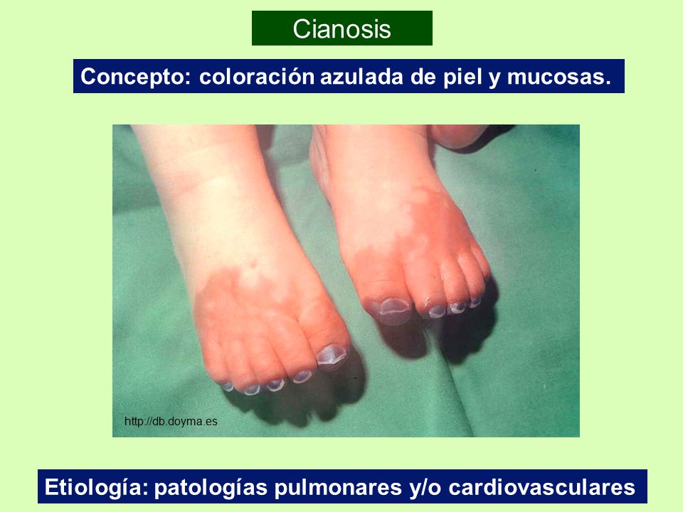 Cianosis Concepto: coloración azulada de piel y mucosas.