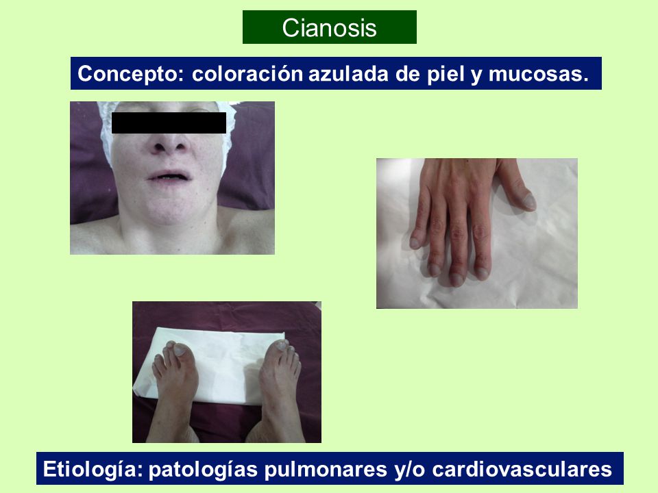 Cianosis Concepto: coloración azulada de piel y mucosas.