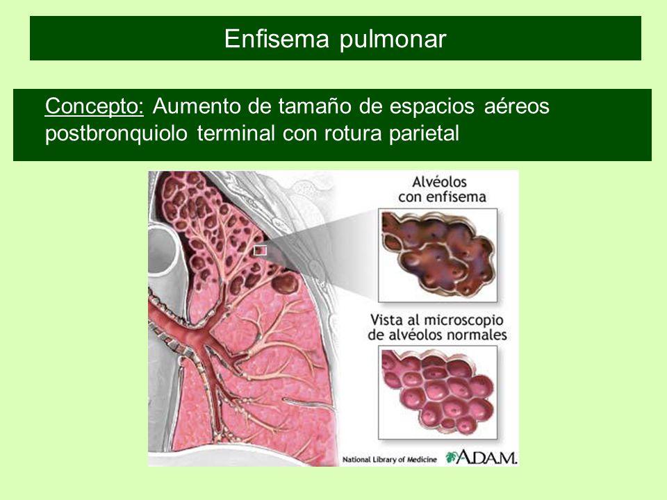 Enfisema pulmonar Concepto: Aumento de tamaño de espacios aéreos postbronquiolo terminal con rotura parietal.