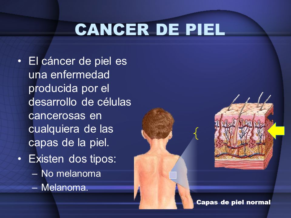 CANCER DE PIEL El cáncer de piel es una enfermedad producida por el desarrollo de células cancerosas en cualquiera de las capas de la piel.