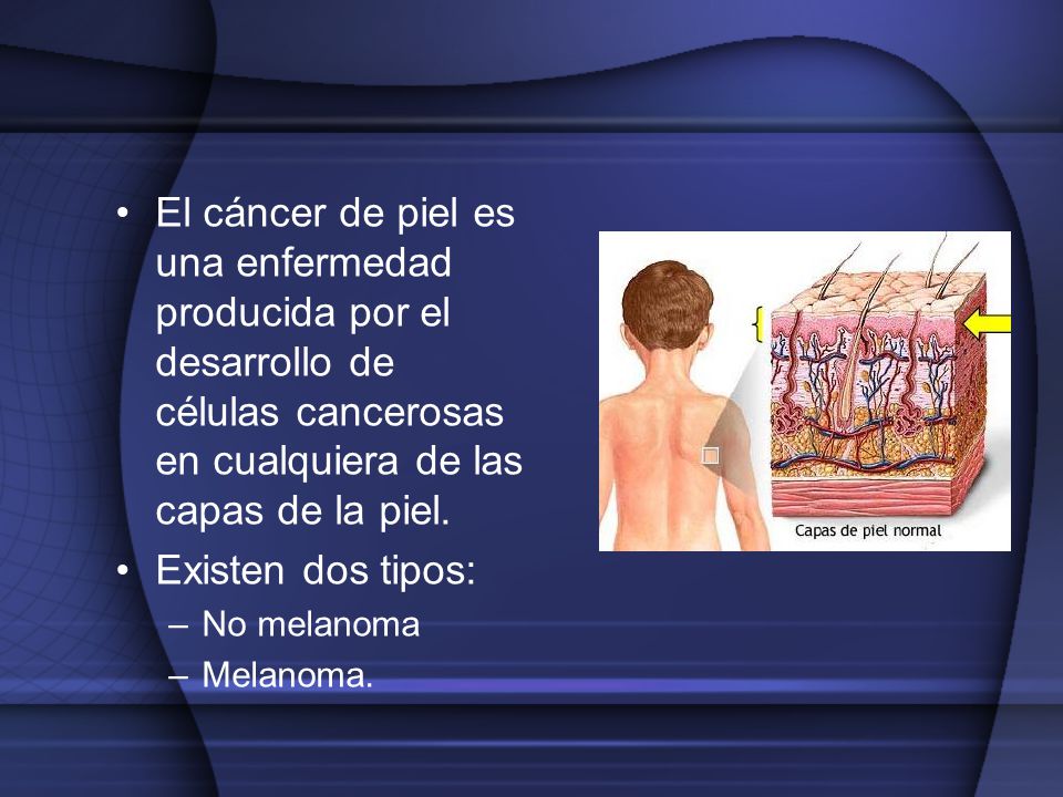 El cáncer de piel es una enfermedad producida por el desarrollo de células cancerosas en cualquiera de las capas de la piel.