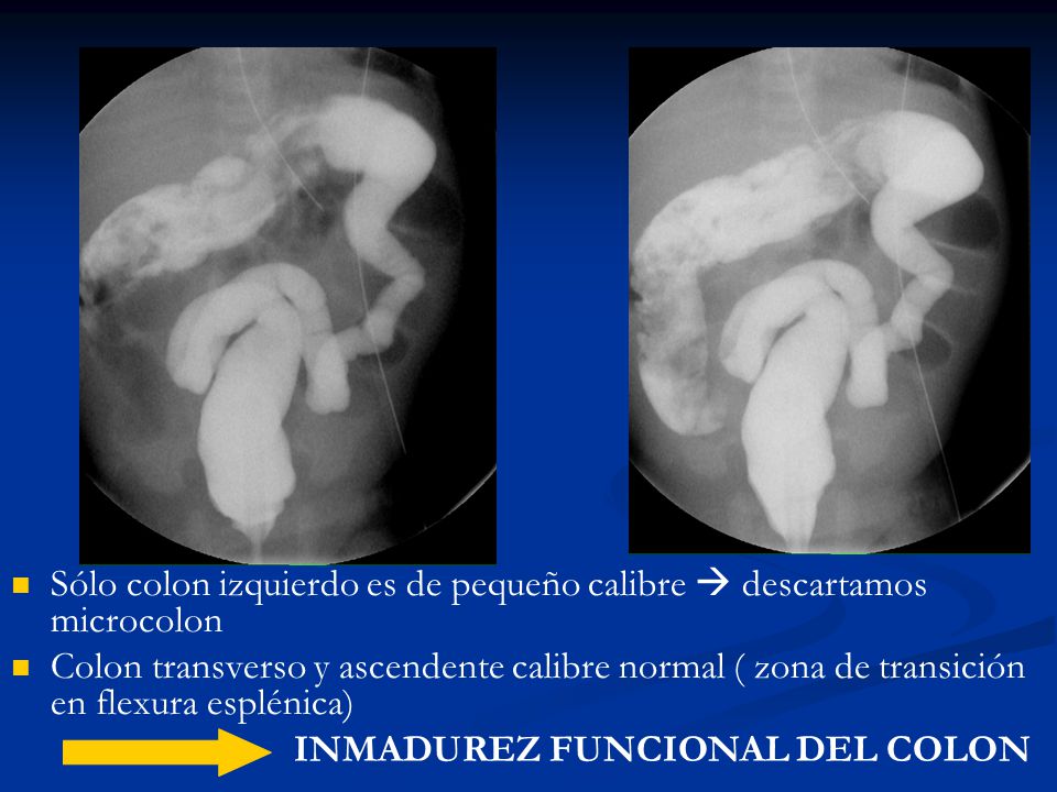 Sólo colon izquierdo es de pequeño calibre  descartamos microcolon