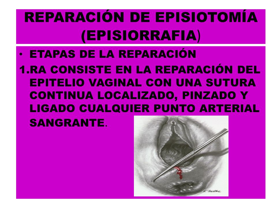 REPARACIÓN DE EPISIOTOMÍA (EPISIORRAFIA)