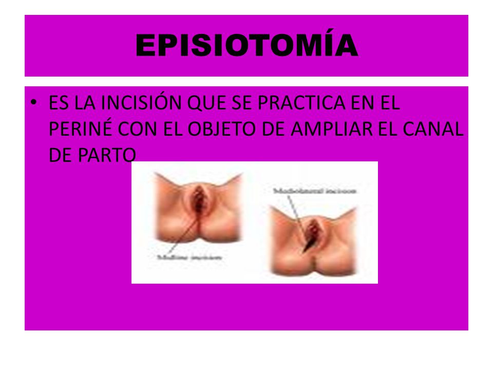 EPISIOTOMÍA ES LA INCISIÓN QUE SE PRACTICA EN EL PERINÉ CON EL OBJETO DE AMPLIAR EL CANAL DE PARTO