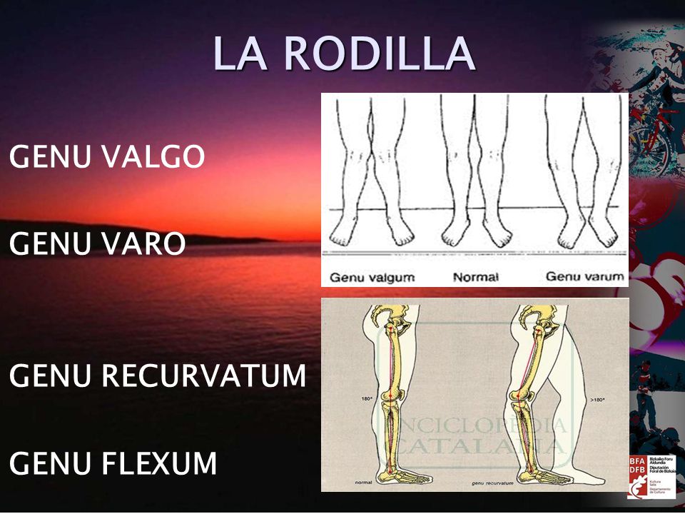 LA RODILLA GENU VALGO GENU VARO GENU RECURVATUM GENU FLEXUM