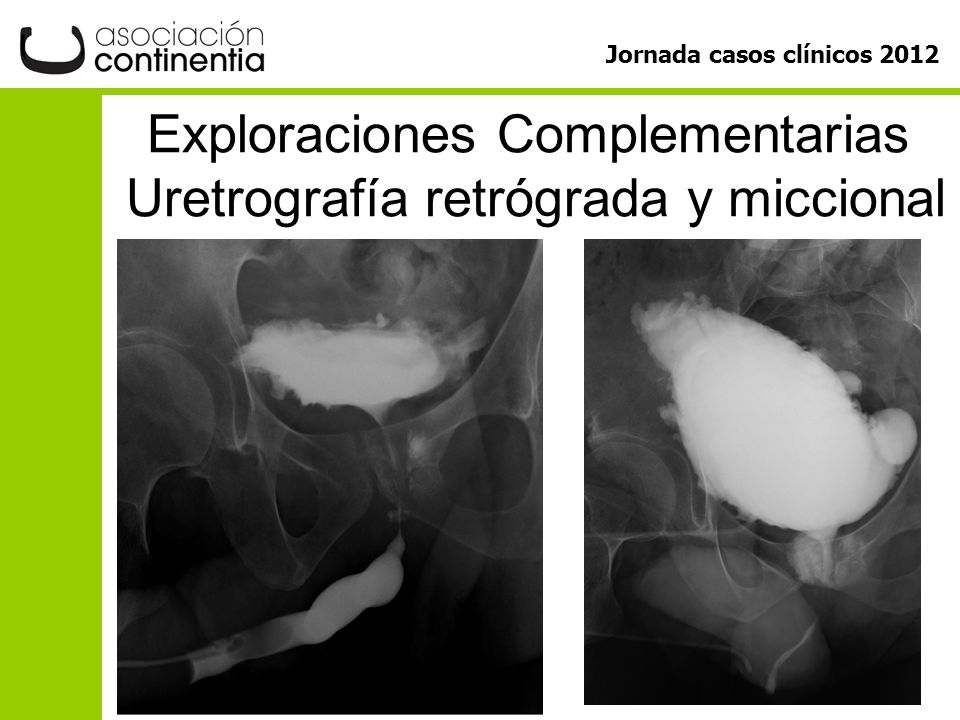 Exploraciones Complementarias Uretrografía retrógrada y miccional