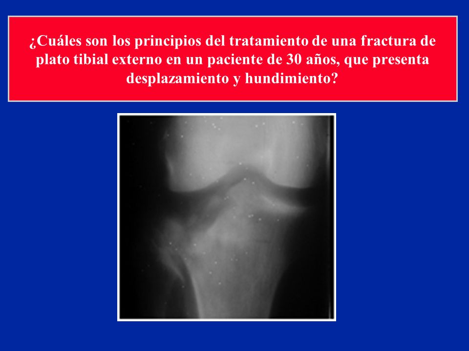 ¿Cuáles son los principios del tratamiento de una fractura de plato tibial externo en un paciente de 30 años, que presenta desplazamiento y hundimiento