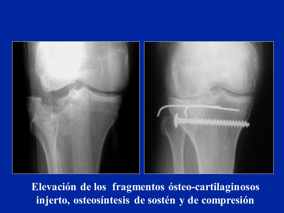 Elevación de los fragmentos ósteo-cartilaginosos injerto, osteosíntesis de sostén y de compresión