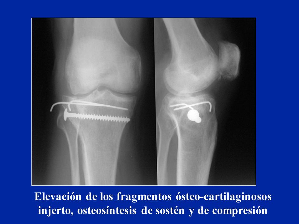 Elevación de los fragmentos ósteo-cartilaginosos injerto, osteosíntesis de sostén y de compresión