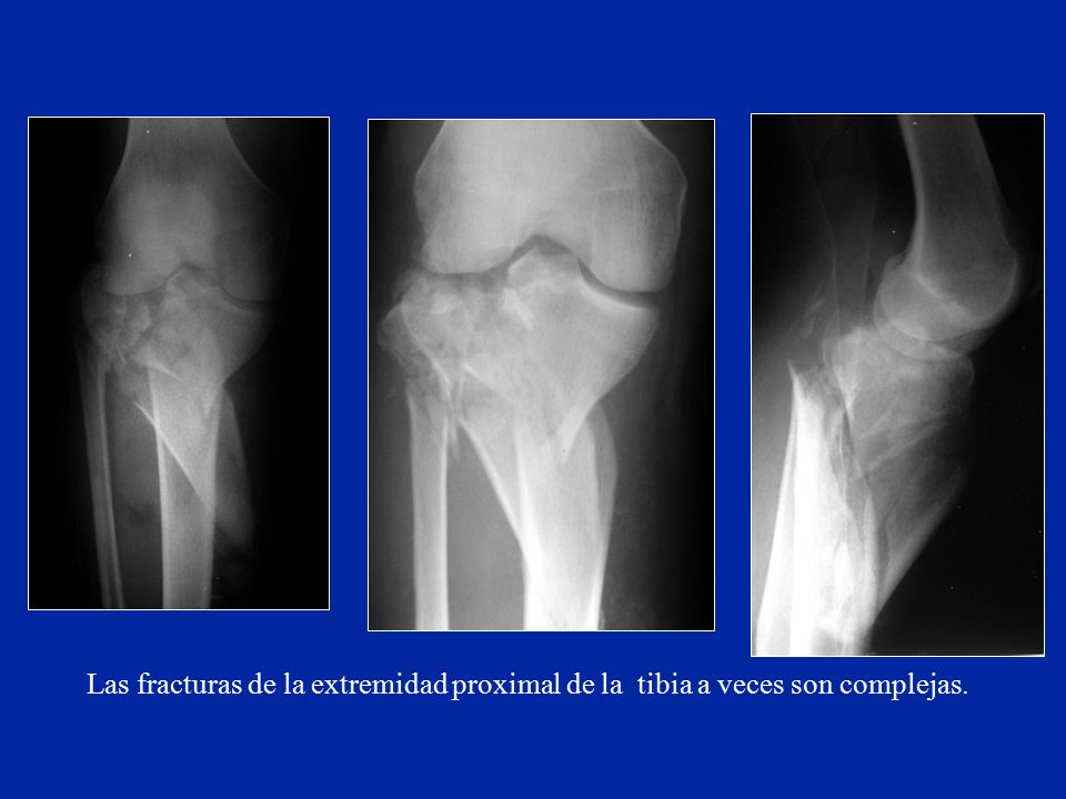 Las fracturas de la extremidad proximal de la tibia a veces son complejas.