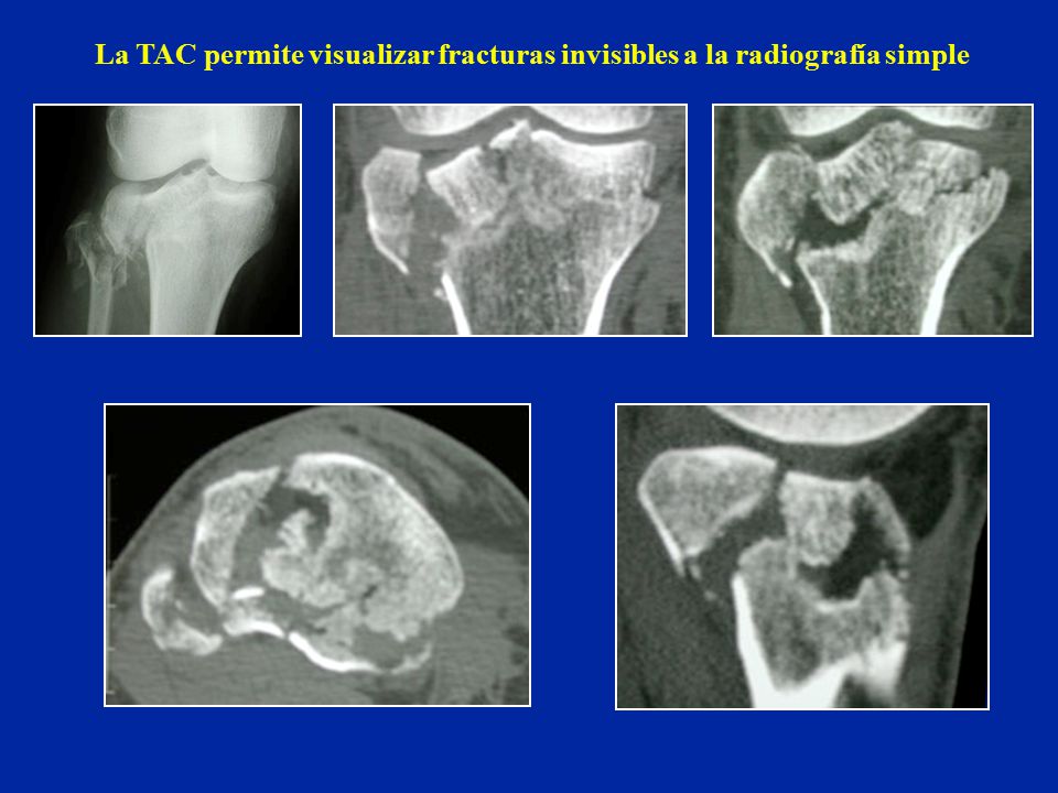 La TAC permite visualizar fracturas invisibles a la radiografía simple