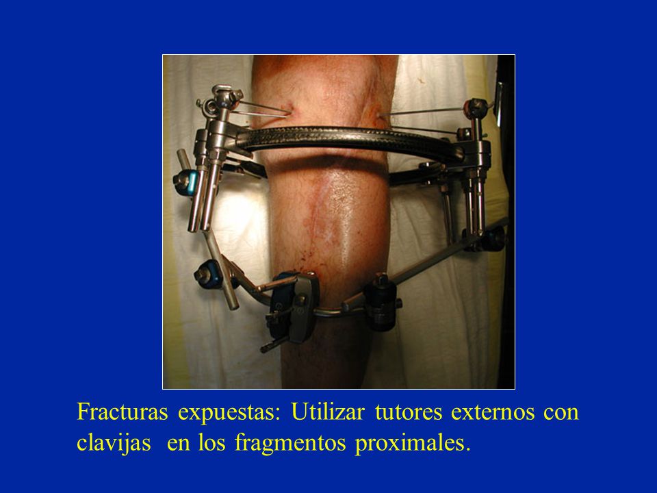 Fracturas expuestas: Utilizar tutores externos con clavijas en los fragmentos proximales.
