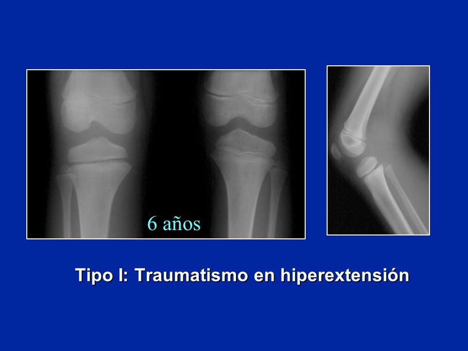 6 años Tipo I: Traumatismo en hiperextensión