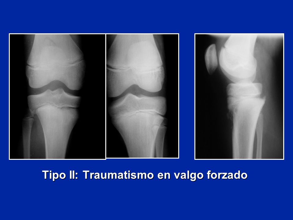 Tipo II: Traumatismo en valgo forzado