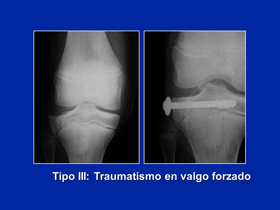 Tipo III: Traumatismo en valgo forzado