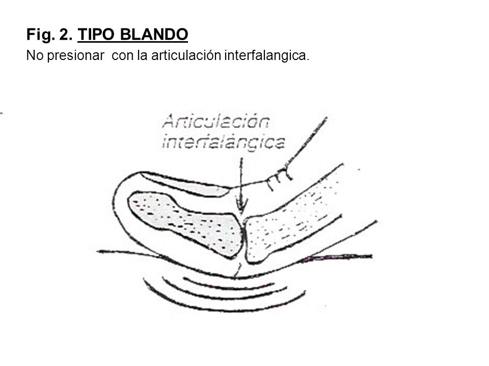 Fig. 2. TIPO BLANDO No presionar con la articulación interfalangica.