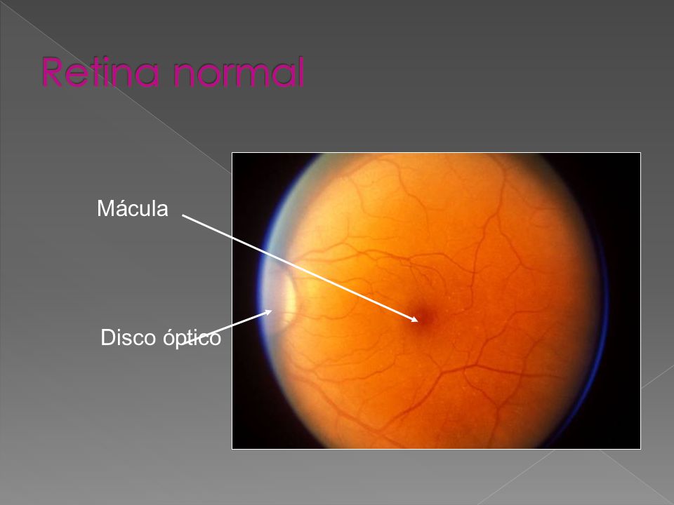 Retina normal Mácula Disco óptico Ésta es una retina izquierda normal.