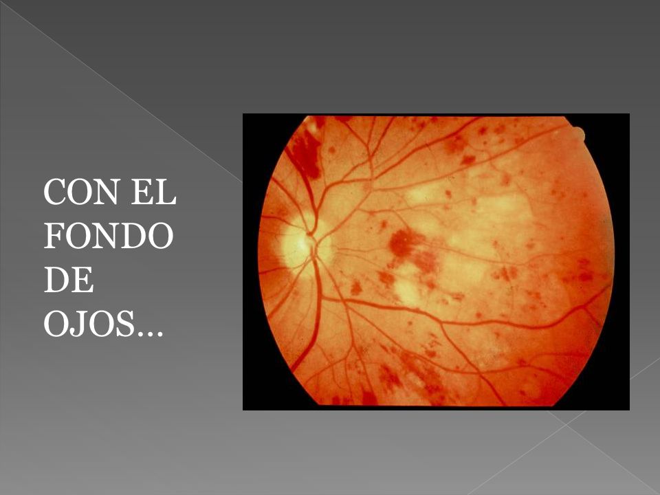CON EL FONDO DE OJOS… Los rasgos que caracterizan la retinopatía no proliferativa grave son: Las venas se muestran distendidas y tortuosas.