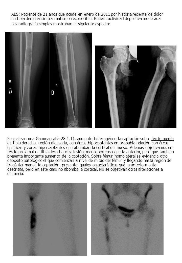 ABS: Paciente de 21 años que acude en enero de 2011 por historia reciente de dolor en tibia derecha sin traumatismo reconocible. Refiere actividad deportiva moderada