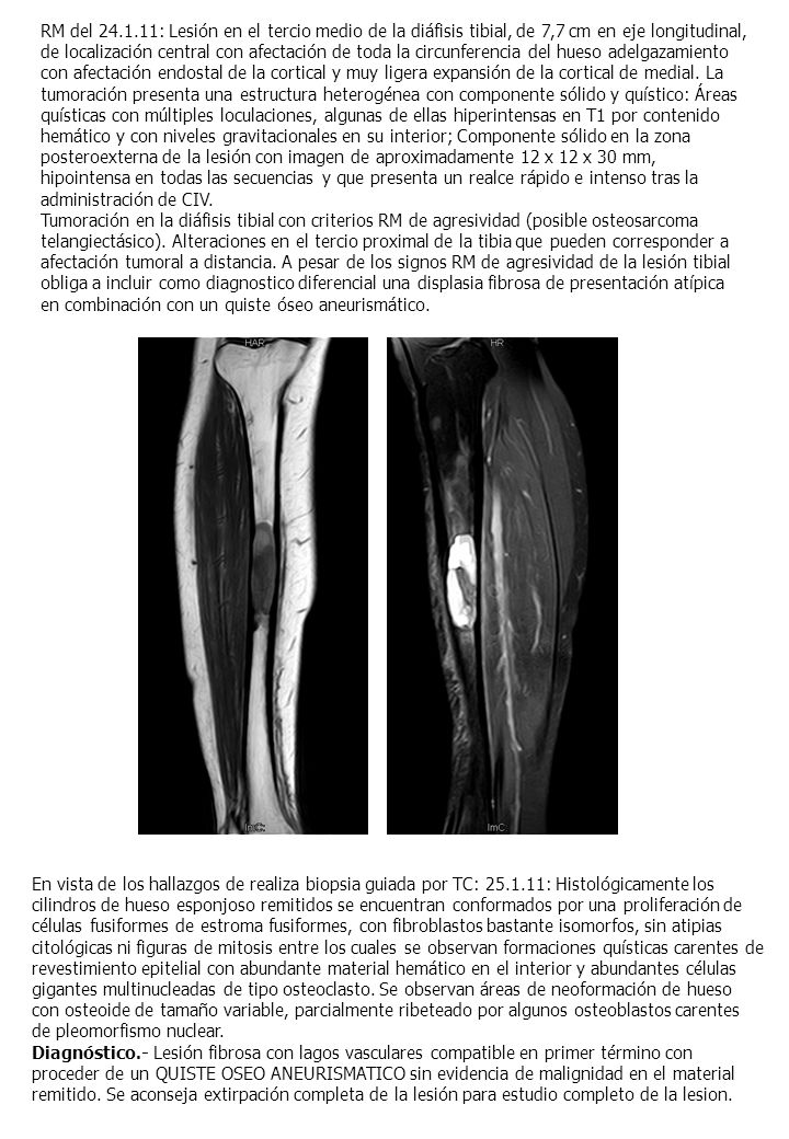 RM del : Lesión en el tercio medio de la diáfisis tibial, de 7,7 cm en eje longitudinal, de localización central con afectación de toda la circunferencia del hueso adelgazamiento con afectación endostal de la cortical y muy ligera expansión de la cortical de medial. La tumoración presenta una estructura heterogénea con componente sólido y quístico: Áreas quísticas con múltiples loculaciones, algunas de ellas hiperintensas en T1 por contenido hemático y con niveles gravitacionales en su interior; Componente sólido en la zona posteroexterna de la lesión con imagen de aproximadamente 12 x 12 x 30 mm, hipointensa en todas las secuencias y que presenta un realce rápido e intenso tras la administración de CIV.