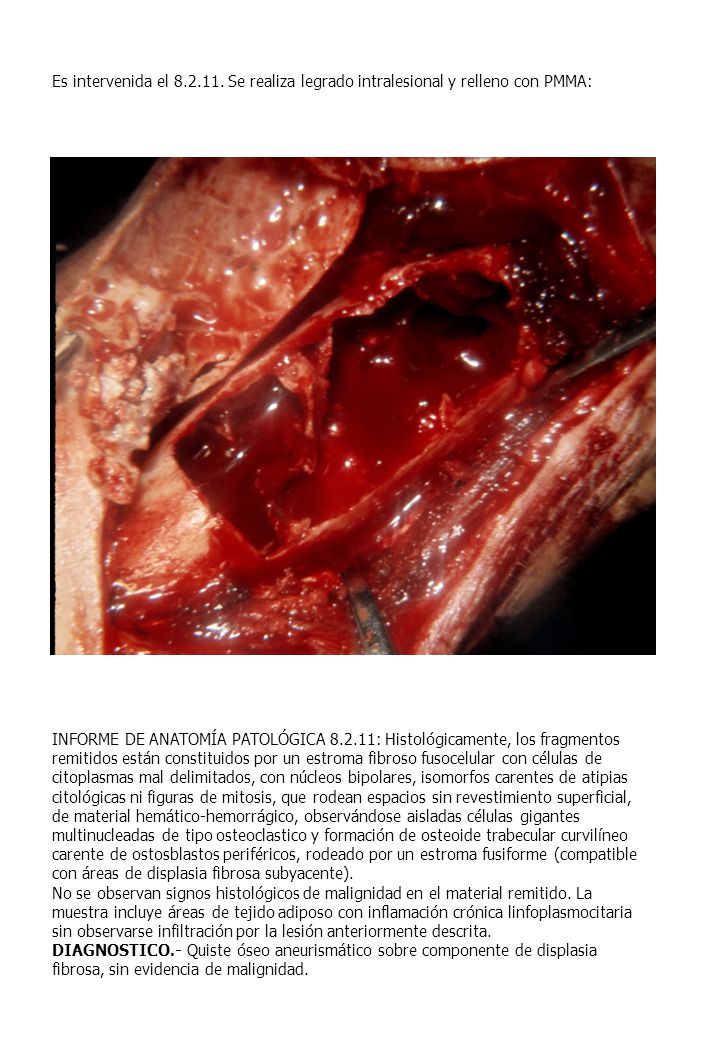 Es intervenida el Se realiza legrado intralesional y relleno con PMMA: