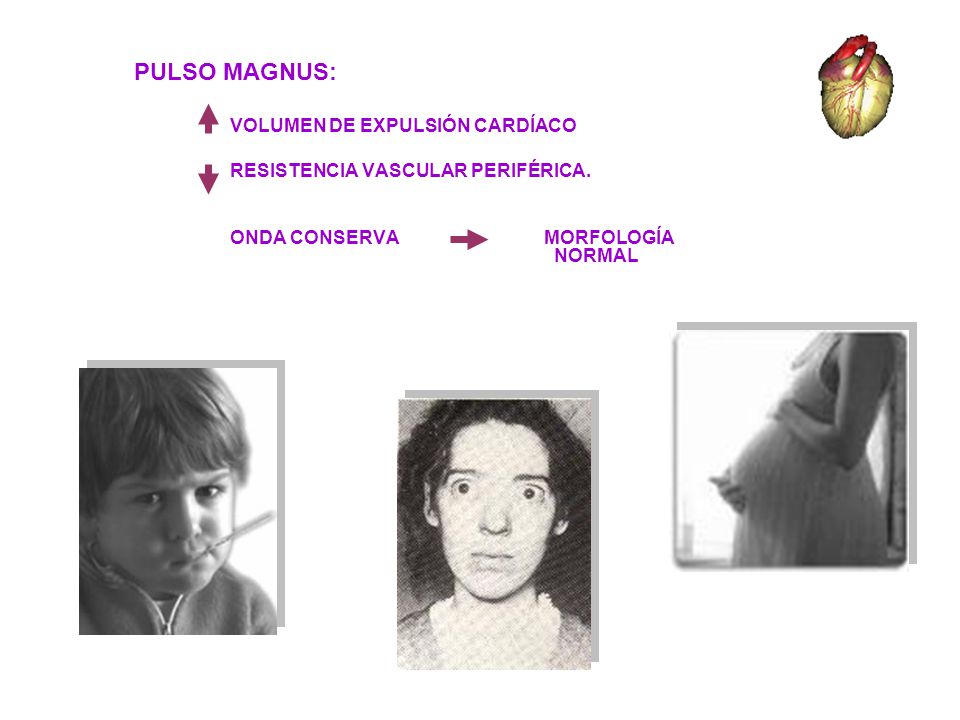 PULSO MAGNUS: VOLUMEN DE EXPULSIÓN CARDÍACO