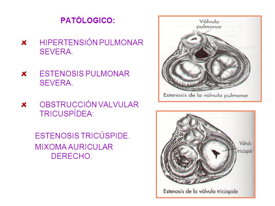 PATÓLOGICO: HIPERTENSIÓN PULMONAR SEVERA. ESTENOSIS PULMONAR SEVERA. OBSTRUCCIÓN VALVULAR TRICUSPÍDEA: