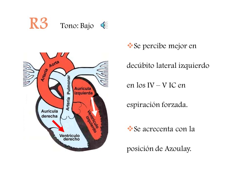 R3 Tono: Bajo. Se percibe mejor en decúbito lateral izquierdo en los IV – V IC en espiración forzada.