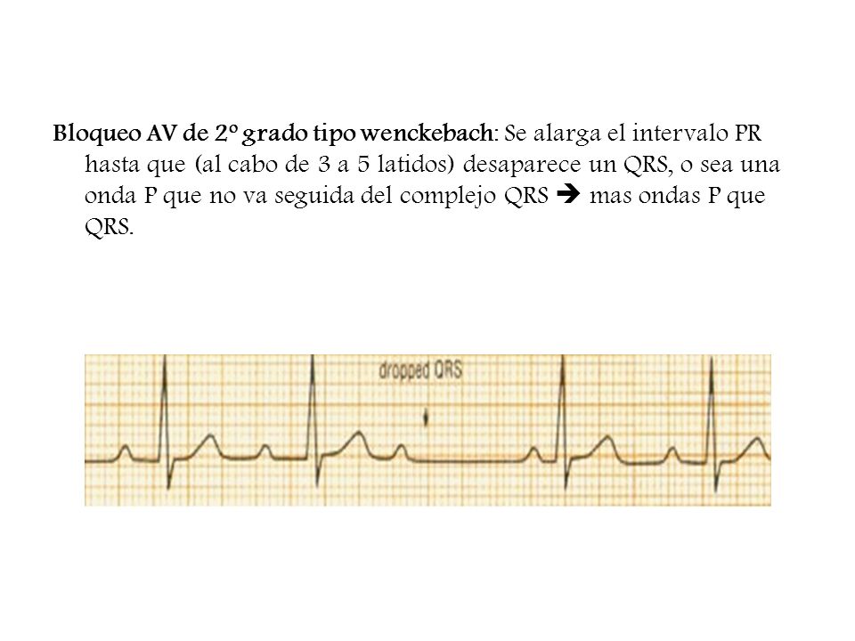 Bloqueo AV de 2º grado tipo wenckebach: Se alarga el intervalo PR hasta que (al cabo de 3 a 5 latidos) desaparece un QRS, o sea una onda P que no va seguida del complejo QRS  mas ondas P que QRS.