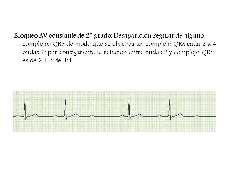 Bloqueo AV constante de 2º grado: Desaparicion regular de alguno complejos QRS de modo que se observa un complejo QRS cada 2 a 4 ondas P; por consiguiente la relacion entre ondas P y complejo QRS es de 2:1 o de 4:1.