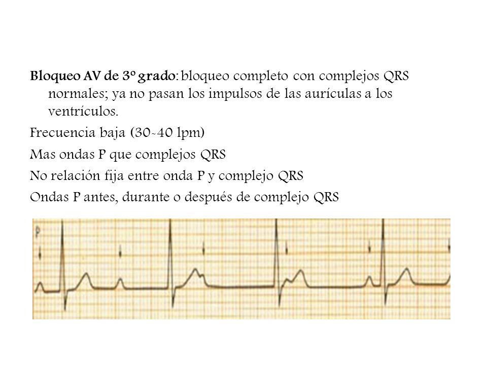 Bloqueo AV de 3º grado: bloqueo completo con complejos QRS normales; ya no pasan los impulsos de las aurículas a los ventrículos.