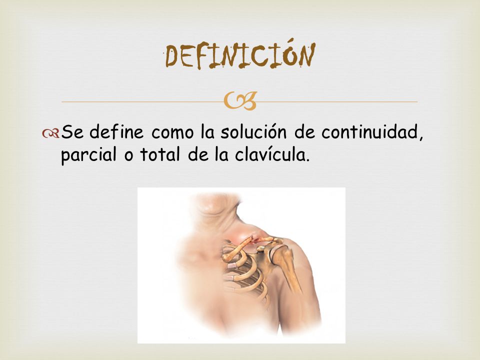 DEFINICIÓN Se define como la solución de continuidad, parcial o total de la clavícula.
