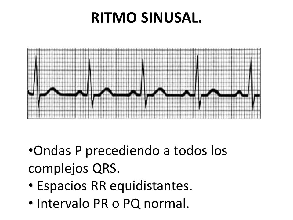 RITMO SINUSAL. Ondas P precediendo a todos los complejos QRS.