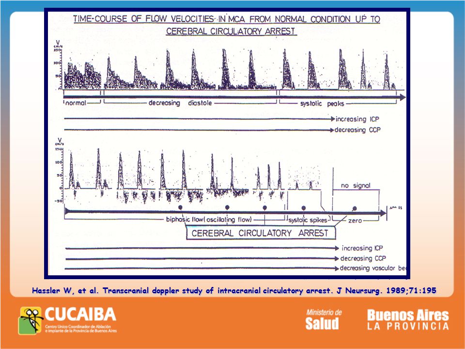 Hassler W, et al. Transcranial doppler study of intracranial circulatory arrest.