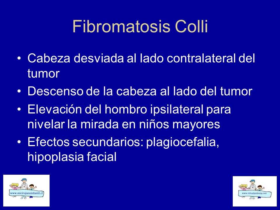 Fibromatosis Colli Cabeza desviada al lado contralateral del tumor