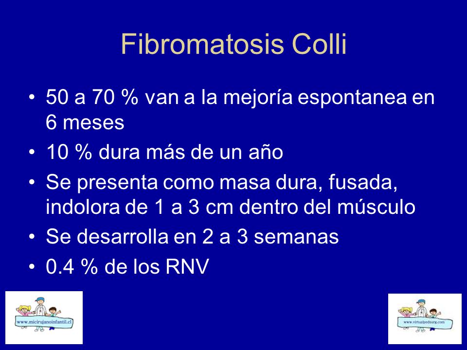 Fibromatosis Colli 50 a 70 % van a la mejoría espontanea en 6 meses