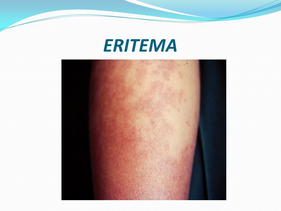 ERITEMA