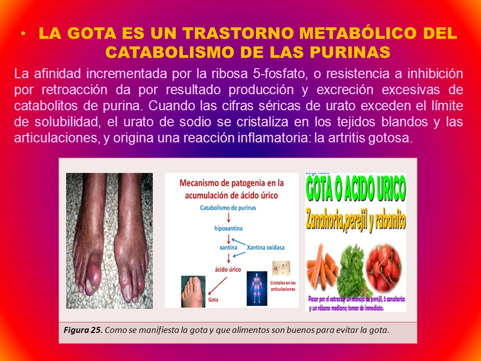 LA GOTA ES UN TRASTORNO METABÓLICO DEL CATABOLISMO DE LAS PURINAS