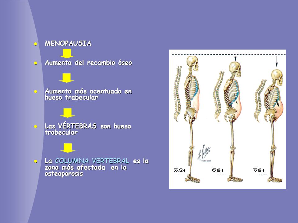 MENOPAUSIA Aumento del recambio óseo. Aumento más acentuado en hueso trabecular. Las VÉRTEBRAS son hueso trabecular.