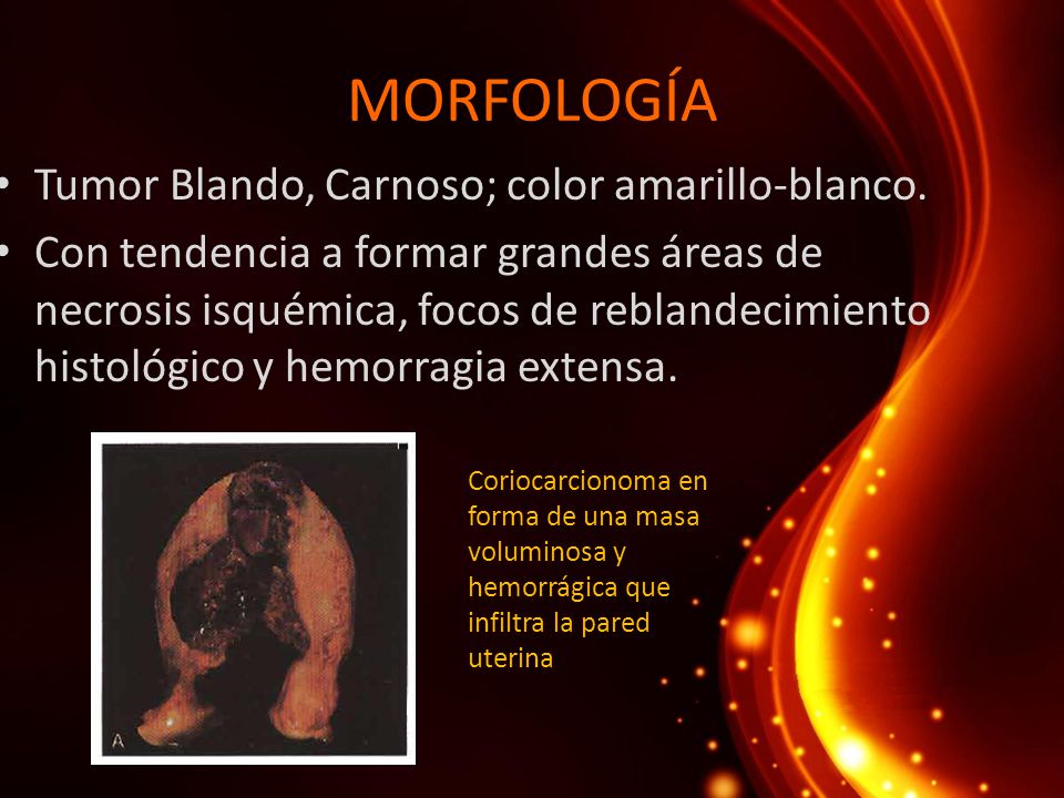 MORFOLOGÍA Tumor Blando, Carnoso; color amarillo-blanco.