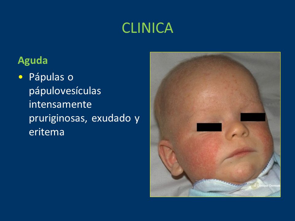 CLINICA Aguda Pápulas o pápulovesículas intensamente pruriginosas, exudado y eritema