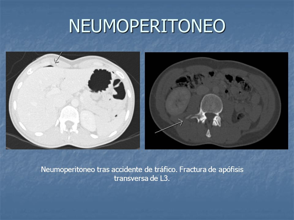 NEUMOPERITONEO Neumoperitoneo tras accidente de tráfico. Fractura de apófisis transversa de L3.