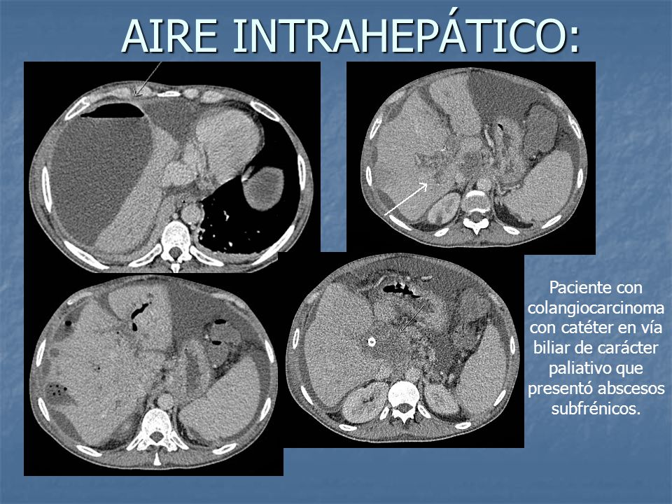 AIRE INTRAHEPÁTICO: Paciente con colangiocarcinoma con catéter en vía biliar de carácter paliativo que presentó abscesos subfrénicos.