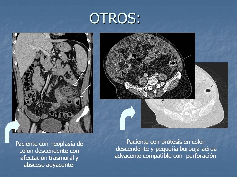 OTROS: Paciente con prótesis en colon descendente y pequeña burbuja aérea adyacente compatible con perforación.