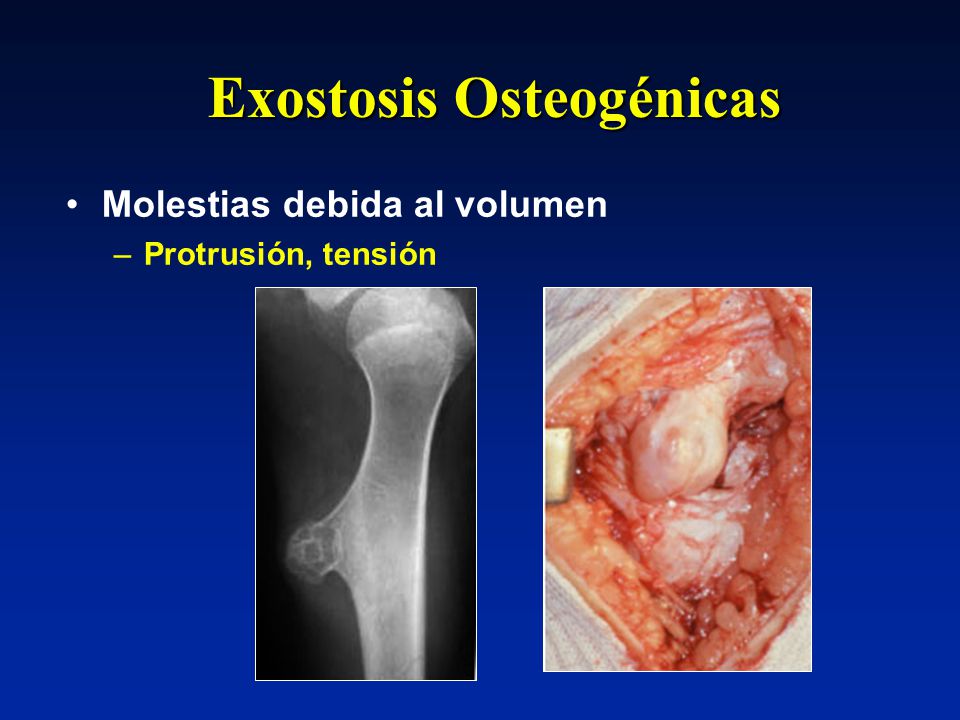 Exostosis Osteogénicas