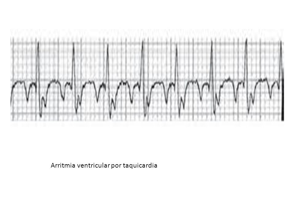 Arritmia ventricular por taquicardia