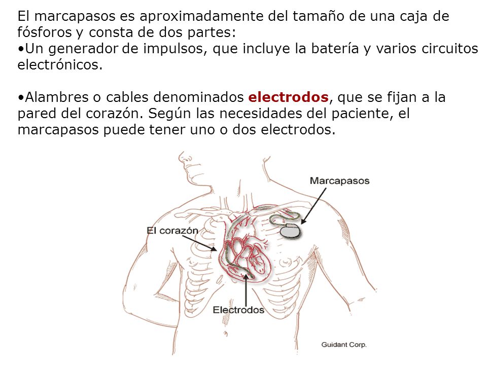 El marcapasos es aproximadamente del tamaño de una caja de fósforos y consta de dos partes: