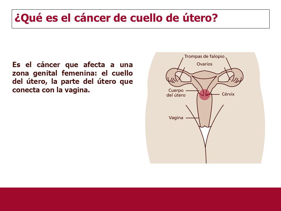 ¿Qué es el cáncer de cuello de útero