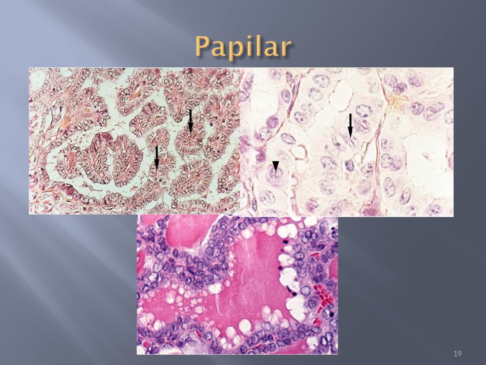 Papilar La variante células altas de carcinoma papilar: 10% - más agresivo.